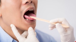 五大癌篩檢：口腔黏膜檢查說明